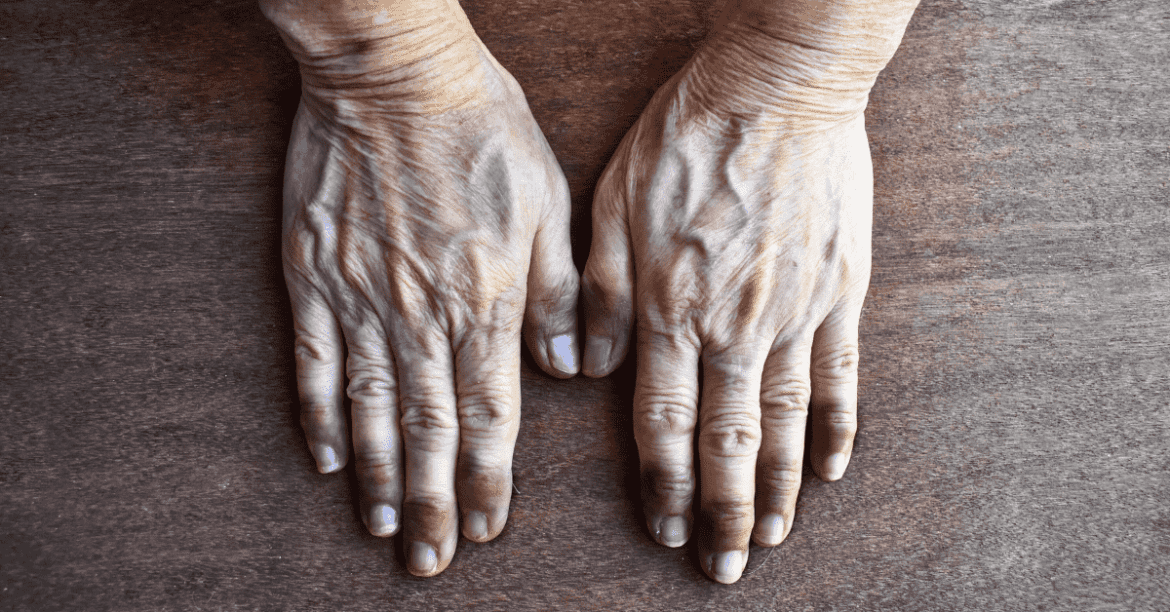 purple fingertips syndrome in elderly